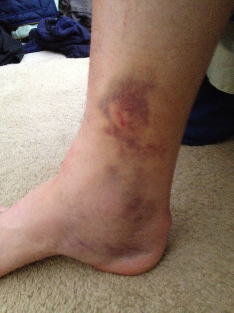 Pauls Hockey Injury.jpg